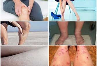 Ոտքերի վրա varicose veins- ի ախտանիշներ