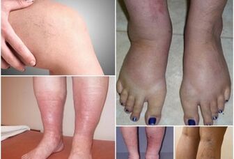 Ոտքերի վրա varicose veins- ի դրսեւորումների լուսանկարներ
