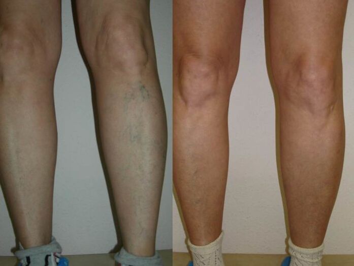 ոտքերը վարիկոզի լազերային բուժումից առաջ և հետո