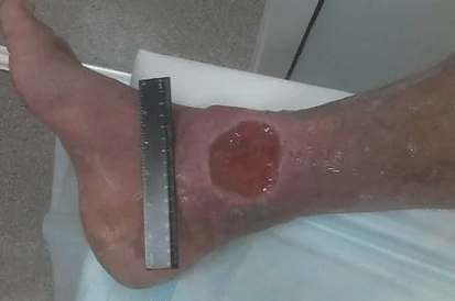 Varicose veins- ի բարդությունները