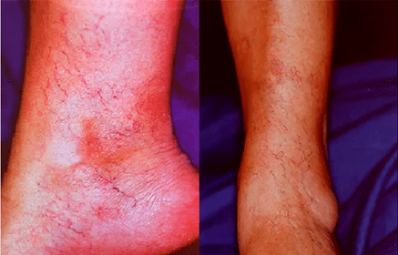 Varicose veins