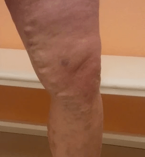 varicose veins
