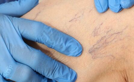Varicose veins- ի ախտանիշներ