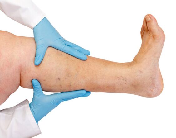 Varicose veins ոտքերի վրա