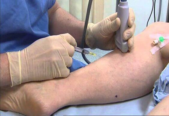 Varicose veins- ի բուժում