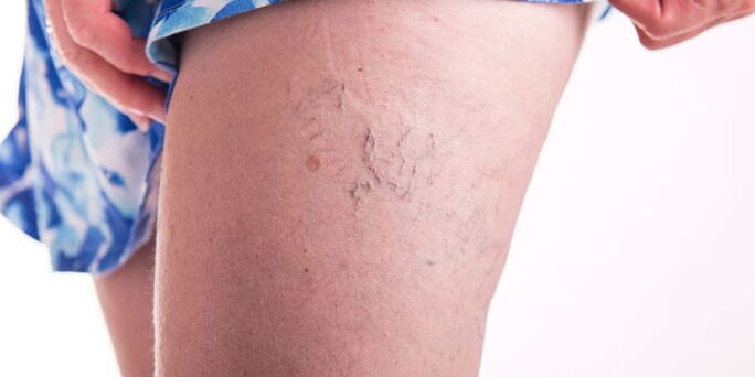 Varicose veins- ի կանխարգելում