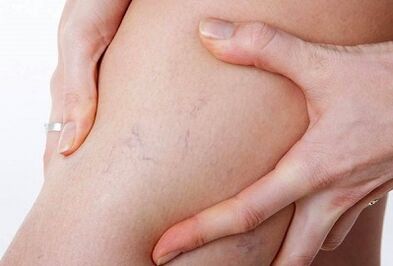 Արգելված գործողություններ varicose veins- ի համար