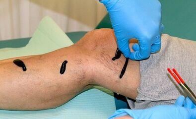 Հիրուդոթերապիա varicose veins- ի համար