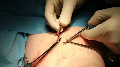 Flebectomy varicose veins- ի համար