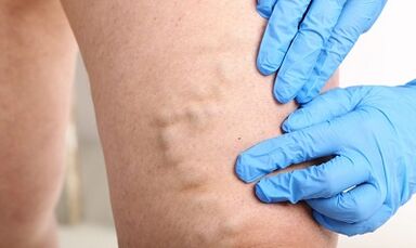 Varicose veins ոտքերի վրա