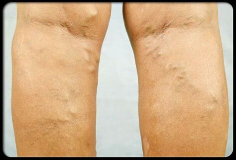Varicose veins ոտքերի վրա