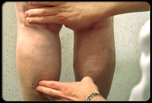 Բժիշկը ոտքերը ուսումնասիրում է varicose veins- ով
