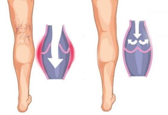 Ինչպիսին են varicose veins- ը