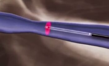 Ջերմային բուժում