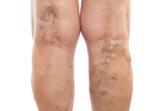 ստորին վերջույթների varicose veins
